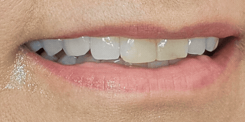 Smile Design - Before and After